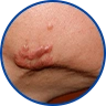 Келоидные рубцы