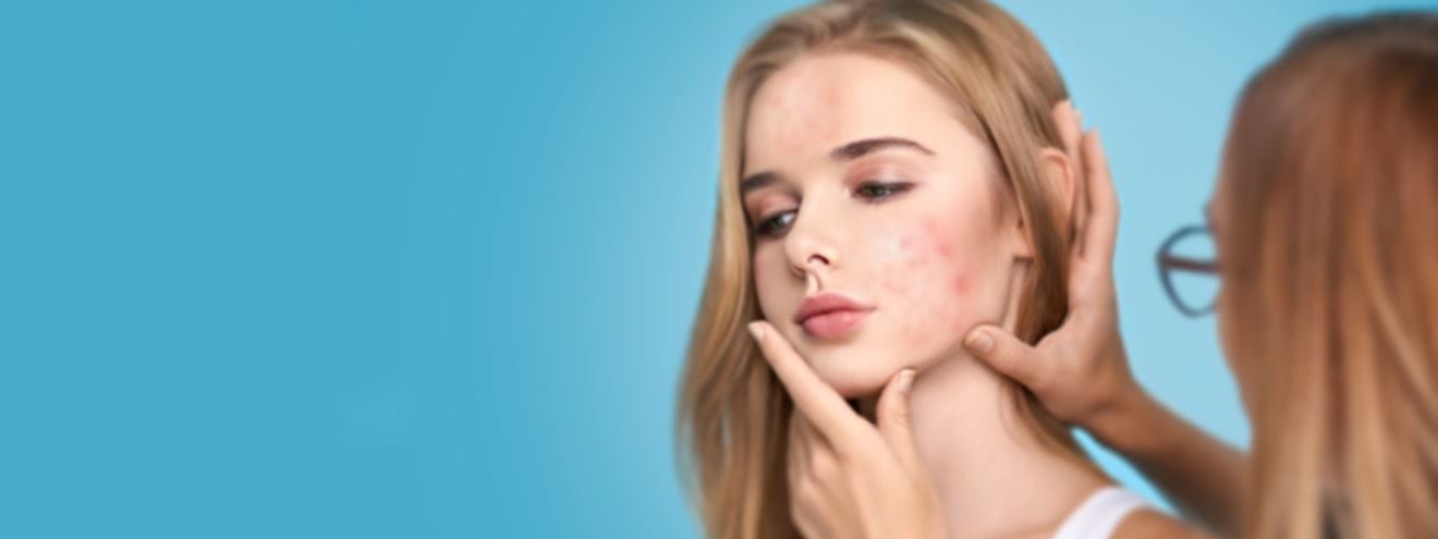 Акнекутан - Лечение угрей на лице у девушек