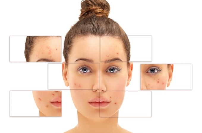 почему появляются прыщи на лице